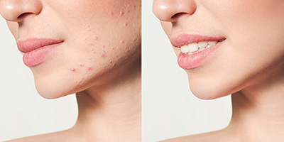 Acne Scar Correction