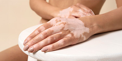 Vitiligo Surgeries